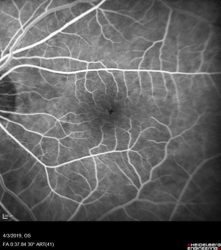 Stellate Non-heredtiary Idiopathic Foveomacular Retinoschisis (SNIFR)
77 year old man who is healthy and 6'6