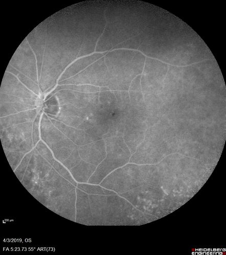 Stellate Non-heredtiary Idiopathic Foveomacular Retinoschisis (SNIFR)
77 year old man who is healthy and 6'6