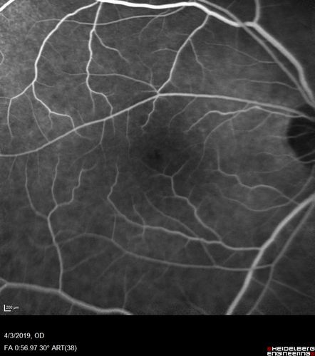 Stellate Non-heredtiary Idiopathic Foveomacular Retinoschisis (SNIFR)
77 year old man who is healthy and 6'6
