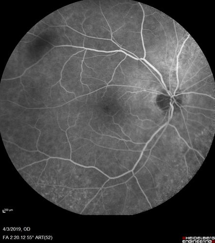 Stellate Non-heredtiary Idiopathic Foveomacular Retinoschisis (SNIFR)
77 year old man who is healthy and 6'6