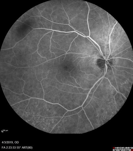 Stellate Non-heredtiary Idiopathic Foveomacular Retinoschisis (SNIFR)
77 year old man who is healthy and 6'6