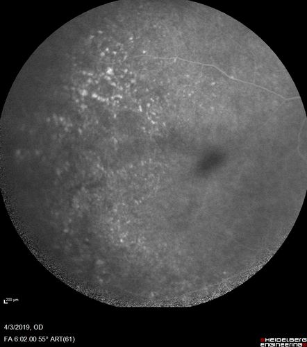 Stellate Non-heredtiary Idiopathic Foveomacular Retinoschisis (SNIFR)
77 year old man who is healthy and 6'6