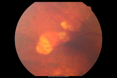 Sclerochoroidal Calcification - 72 Year Old Woman 
72-year-old woman who has spots on her lungs, which she has been told are scar tissue 20/30 OU
