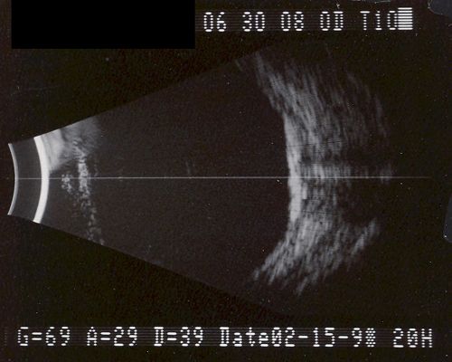 Sclerochoroidal Calcification - 72 Year Old Woman 
72-year-old woman who has spots on her lungs, which she has been told are scar tissue 20/30 OU
