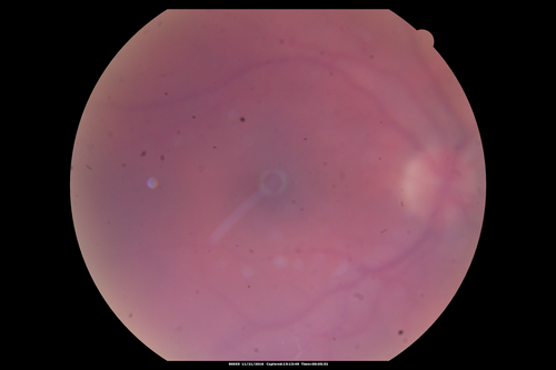 Scleromalacia and Uveitis
Poor vision from uveitis and cataract.  She was treated with Remicade and the uveitis abated and she had the right eye cataract done.  The initial vision was 20/400 OD, 20/200 OS  Final vision 20/60 OD, 20/32 OS
