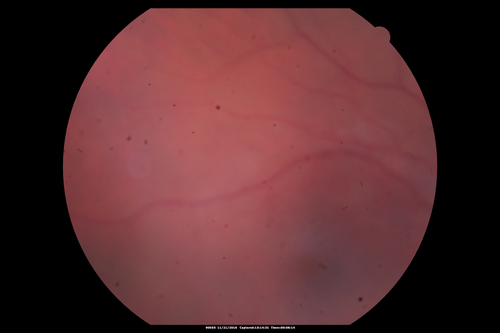 Scleromalacia and Uveitis
Poor vision from uveitis and cataract.  She was treated with Remicade and the uveitis abated and she had the right eye cataract done.  The initial vision was 20/400 OD, 20/200 OS  Final vision 20/60 OD, 20/32 OS
