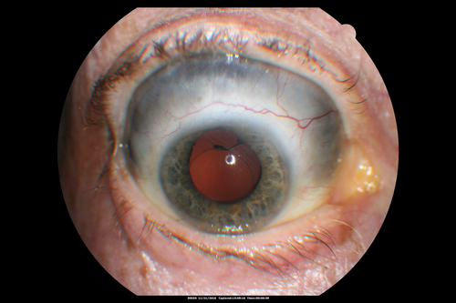 Scleromalacia and Uveitis
Poor vision from uveitis and cataract.  She was treated with Remicade and the uveitis abated and she had the right eye cataract done.  The initial vision was 20/400 OD, 20/200 OS  Final vision 20/60 OD, 20/32 OS
