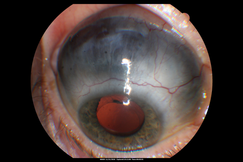 Scleromalacia and Uveitis
Poor vision from uveitis and cataract.  She was treated with Remicade and the uveitis abated and she had the right eye cataract done.  The initial vision was 20/400 OD, 20/200 OS  Final vision 20/60 OD, 20/32 OS
