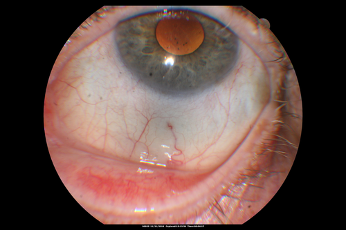 Scleromalacia and Uveitis
Poor vision from uveitis and cataract.  She was treated with Remicade and the uveitis abated and she had the right eye cataract done.  The initial vision was 20/400 OD, 20/200 OS  Final vision 20/60 OD, 20/32 OS
