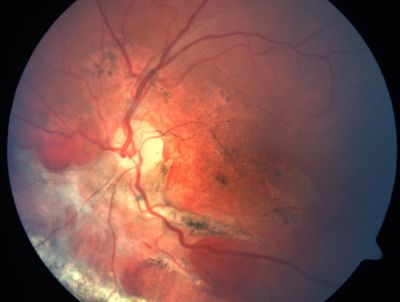 Sclopteria Chorioretinitis - 16 Year Old Girl - Pellet Injury
Keywords: trauma; scar; sclopteria chorioretinitis; non-penetrating; non-perforating