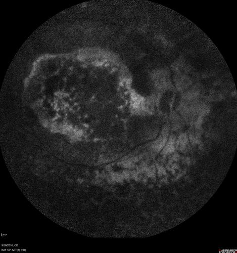 Enhanced S Cone Syndrome - Goldmann Favre - NR2E3 Mutation
82 year old man with poor vision for many years.  VA HM OD, 5/200 OS. Diagnosed at age 12 with retinitis pigmentosa. Nystagmus.

