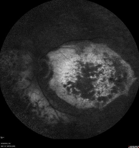 Enhanced S Cone Syndrome - Goldmann Favre - NR2E3 Mutation
82 year old man with poor vision for many years.  VA HM OD, 5/200 OS. Diagnosed at age 12 with retinitis pigmentosa. Nystagmus.
