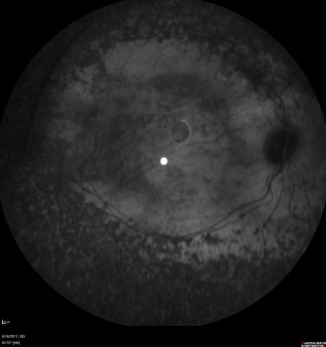 Enhanced S Cone Syndrome - Goldmann Favre - NR2E3 Mutation
82 year old man with poor vision for many years.  VA HM OD, 5/200 OS. Diagnosed at age 12 with retinitis pigmentosa. Nystagmus.
