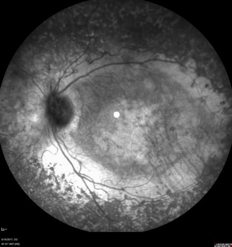 Enhanced S Cone Syndrome - Goldmann Favre - NR2E3 Mutation
82 year old man with poor vision for many years.  VA HM OD, 5/200 OS. Diagnosed at age 12 with retinitis pigmentosa. Nystagmus.
