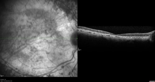 Enhanced S Cone Syndrome - Goldmann Favre - NR2E3 Mutation
82 year old man with poor vision for many years.  VA HM OD, 5/200 OS. Diagnosed at age 12 with retinitis pigmentosa. Nystagmus.
