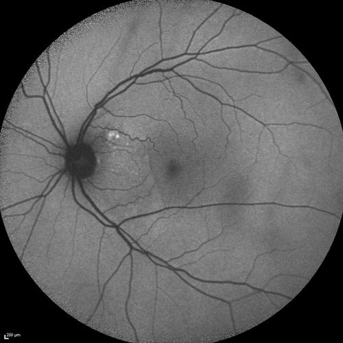 Serous Macular Detachment Both Eyes - Wet AMD vs. CSR - 62 Year Old Man - FAF
