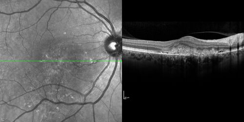 Serous Macular Detachment Both Eyes - Wet AMD vs. CSR - 62 Year Old Man - SD - OCT
