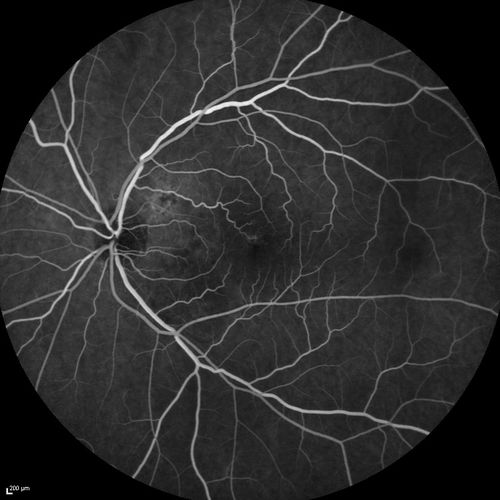 Serous Macular Detachment Both Eyes - Wet AMD vs. CSR - 62 Year Old Man - Fluorescein angiogram
