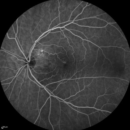 Serous Macular Detachment Both Eyes - Wet AMD vs. CSR - 62 Year Old Man - Fluorescein angiogram
