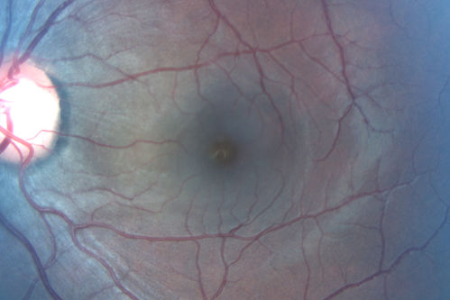 Central Serous Retinopathy 25 year old professional baseball player - Atypical - Choroidal Hypo-perfusion?

