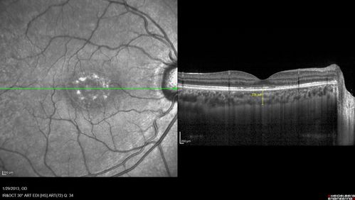 Central Serous Retinopathy 25 year old professional baseball player - Atypical - Choroidal Hypo-perfusion?
