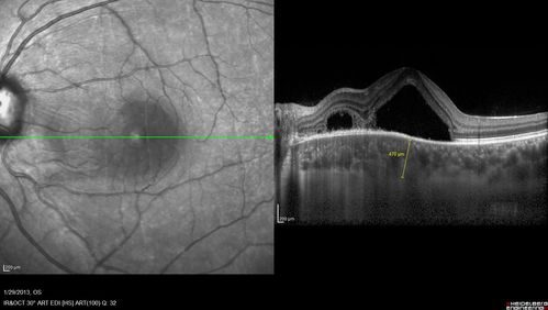 Central Serous Retinopathy 25 year old professional baseball player - Atypical - Choroidal Hypo-perfusion?
