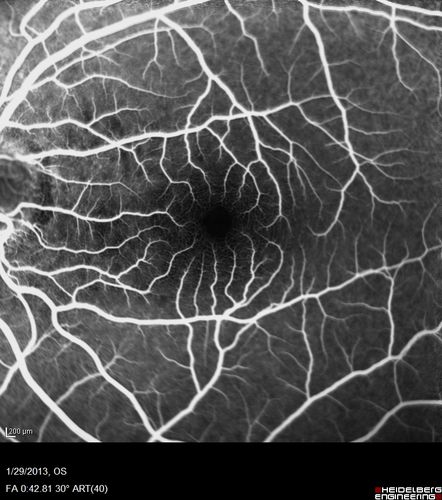 Central Serous Retinopathy 25 year old professional baseball player - Atypical - Choroidal Hypo-perfusion?Central Serous Retinopathy 25 year old professional baseball player - Atypical - Choroidal Hypo-perfusion?
