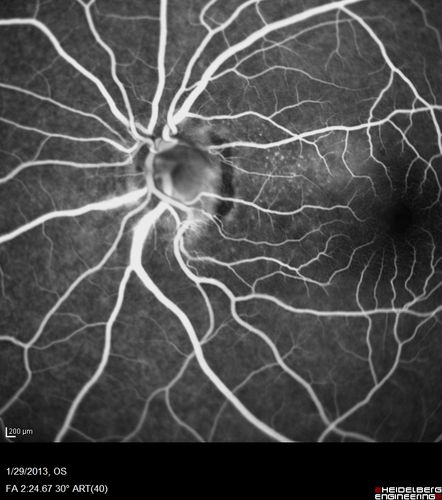 Central Serous Retinopathy 25 year old professional baseball player - Atypical - Choroidal Hypo-perfusion?
