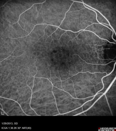 Central Serous Retinopathy 25 year old professional baseball player - Atypical - Choroidal Hypo-perfusion?
