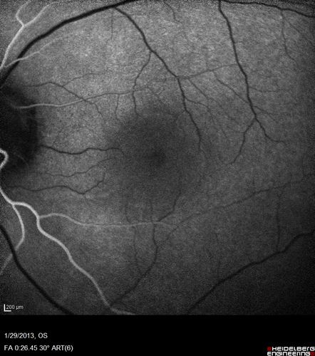 Central Serous Retinopathy 25 year old professional baseball player - Atypical - Choroidal Hypo-perfusion?
