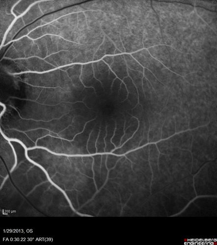 Central Serous Retinopathy 25 year old professional baseball player - Atypical - Choroidal Hypo-perfusion?
