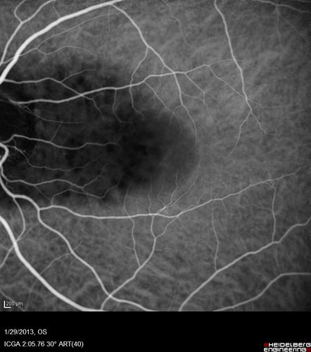 Central Serous Retinopathy 25 year old professional baseball player - Atypical - Choroidal Hypo-perfusion?
