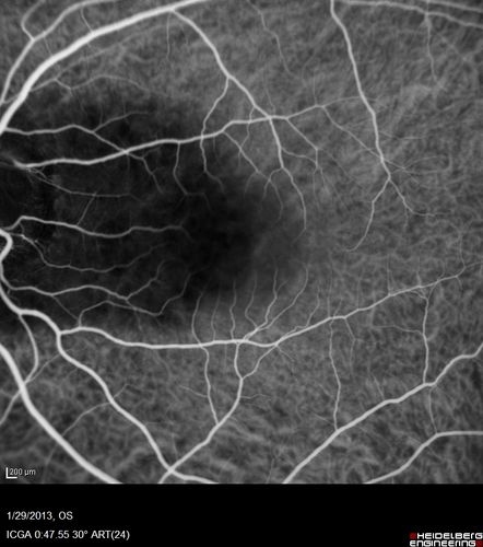 Central Serous Retinopathy 25 year old professional baseball player - Atypical - Choroidal Hypo-perfusion?
