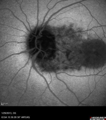 Central Serous Retinopathy 25 year old professional baseball player - Atypical - Choroidal Hypo-perfusion?
