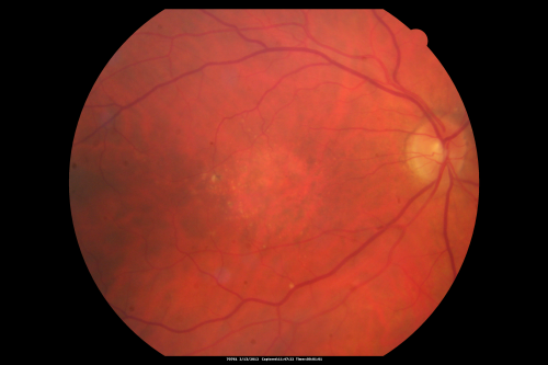 Cuticular Drusen (Basal Laminar Drusen) and Bilateral Chronic Subfoveal Fluid (Serous Retinal Detachment) unresponsive to monthly Avastin 
66-year-old man with bilateral subfoveal fluid unresponsive to one year of monthly avastin therapy.
OD 20/160,  Pinhole 20/80.   OS 20/63,  Pinhole 20/50.  OCT scan shows subretinal fluid with normal choroidal thickness.  Fluorescein angiogram shows cuticular/basal laminar drusen.  ICG shows no foci of choriocapillaris leakage.

