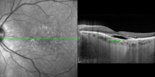 Cuticular Drusen (Basal Laminar Drusen) and Bilateral Chronic Subfoveal Fluid (Serous Retinal Detachment) unresponsive to monthly Avastin OCT OS
66-year-old man with bilateral subfoveal fluid unresponsive to one year of monthly avastin therapy.
OD 20/160,  Pinhole 20/80.   OS 20/63,  Pinhole 20/50.  OCT scan shows subretinal fluid with normal choroidal thickness.  Fluorescein angiogram shows cuticular/basal laminar drusen.  ICG shows no foci of choriocapillaris leakage.

