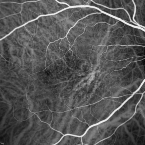 Cuticular Drusen (Basal Laminar Drusen) and Bilateral Chronic Subfoveal Fluid (Serous Retinal Detachment) unresponsive to monthly Avastin Very Early ICG OD
66-year-old man with bilateral subfoveal fluid unresponsive to one year of monthly avastin therapy.
OD 20/160,  Pinhole 20/80.   OS 20/63,  Pinhole 20/50.  OCT scan shows subretinal fluid with normal choroidal thickness.  Fluorescein angiogram shows cuticular/basal laminar drusen.  ICG shows no foci of choriocapillaris leakage.

