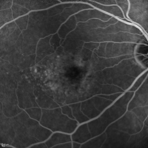 Cuticular Drusen (Basal Laminar Drusen) and Bilateral Chronic Subfoveal Fluid (Serous Retinal Detachment) unresponsive to monthly Avastin Early FA OD
66-year-old man with bilateral subfoveal fluid unresponsive to one year of monthly avastin therapy.
OD 20/160,  Pinhole 20/80.   OS 20/63,  Pinhole 20/50.  OCT scan shows subretinal fluid with normal choroidal thickness.  Fluorescein angiogram shows cuticular/basal laminar drusen.  ICG shows no foci of choriocapillaris leakage.

