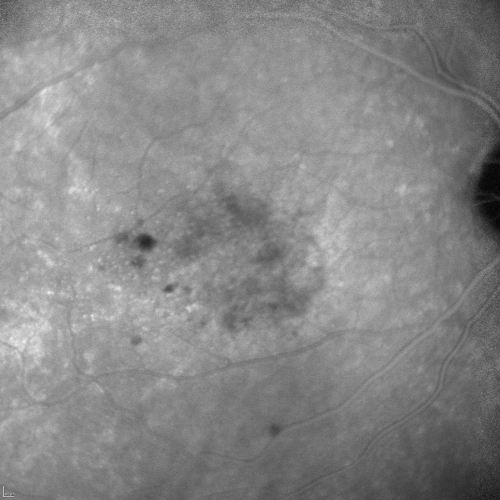 Cuticular Drusen (Basal Laminar Drusen) and Bilateral Chronic Subfoveal Fluid (Serous Retinal Detachment) unresponsive to monthly Avastin 5 minute ICG OD
66-year-old man with bilateral subfoveal fluid unresponsive to one year of monthly avastin therapy.
OD 20/160,  Pinhole 20/80.   OS 20/63,  Pinhole 20/50.  OCT scan shows subretinal fluid with normal choroidal thickness.  Fluorescein angiogram shows cuticular/basal laminar drusen.  ICG shows no foci of choriocapillaris leakage.

