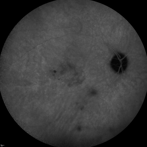 Cuticular Drusen (Basal Laminar Drusen) and Bilateral Chronic Subfoveal Fluid (Serous Retinal Detachment) unresponsive to monthly Avastin 15 Minute ICG OD
66-year-old man with bilateral subfoveal fluid unresponsive to one year of monthly avastin therapy.
OD 20/160,  Pinhole 20/80.   OS 20/63,  Pinhole 20/50.  OCT scan shows subretinal fluid with normal choroidal thickness.  Fluorescein angiogram shows cuticular/basal laminar drusen.  ICG shows no foci of choriocapillaris leakage.

