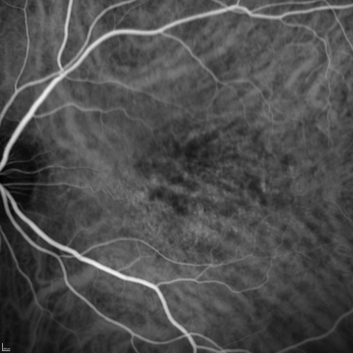 Cuticular Drusen (Basal Laminar Drusen) and Bilateral Chronic Subfoveal Fluid (Serous Retinal Detachment) unresponsive to monthly Avastin ICG OS
66-year-old man with bilateral subfoveal fluid unresponsive to one year of monthly avastin therapy.
OD 20/160,  Pinhole 20/80.   OS 20/63,  Pinhole 20/50.  OCT scan shows subretinal fluid with normal choroidal thickness.  Fluorescein angiogram shows cuticular/basal laminar drusen.  ICG shows no foci of choriocapillaris leakage.

