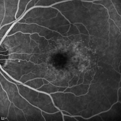 Cuticular Drusen (Basal Laminar Drusen) and Bilateral Chronic Subfoveal Fluid (Serous Retinal Detachment) unresponsive to monthly Avastin FA OS
66-year-old man with bilateral subfoveal fluid unresponsive to one year of monthly avastin therapy.
OD 20/160,  Pinhole 20/80.   OS 20/63,  Pinhole 20/50.  OCT scan shows subretinal fluid with normal choroidal thickness.  Fluorescein angiogram shows cuticular/basal laminar drusen.  ICG shows no foci of choriocapillaris leakage.

