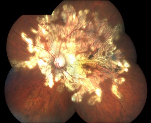 Serpiginouse Choroiditis (Chorioretinitis) - Acute Right Eye - Old Left Eye VA 20/25 OD , 20/50 OS
63-year-old woman has serpiginous choroiditis (date - March 2011).  The right eye has not been previously involved, and then she noticed new onset floaters in the right eye for the last two weeks.  Her vision in the right eye is hazy because of that.

VISUAL ACUITY:  Vision OD is 20/25, OS is 20/50
