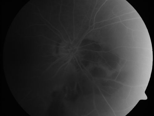 Serpiginouse Choroiditis (Chorioretinitis) - Acute Right Eye - Old Left Eye VA 20/25 OD , 20/50 OS
63-year-old woman has serpiginous choroiditis (date - March 2011).  The right eye has not been previously involved, and then she noticed new onset floaters in the right eye for the last two weeks.  Her vision in the right eye is hazy because of that.

VISUAL ACUITY:  Vision OD is 20/25, OS is 20/50
