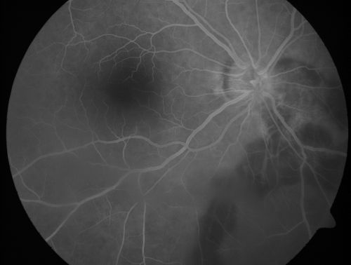Serpiginouse Choroiditis (Chorioretinitis) - Acute Right Eye - Old Left Eye VA 20/25 OD , 20/50 OS
63-year-old woman has serpiginous choroiditis (date - March 2011).  The right eye has not been previously involved, and then she noticed new onset floaters in the right eye for the last two weeks.  Her vision in the right eye is hazy because of that.

VISUAL ACUITY:  Vision OD is 20/25, OS is 20/50
