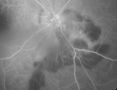 Serpiginouse Choroiditis (Chorioretinitis) - Acute Right Eye - Old Left Eye VA 20/25 OD , 20/50 OS
63-year-old woman has serpiginous choroiditis (date - March 2011).  The right eye has not been previously involved, and then she noticed new onset floaters in the right eye for the last two weeks.  Her vision in the right eye is hazy because of that.

VISUAL ACUITY:  Vision OD is 20/25, OS is 20/50

