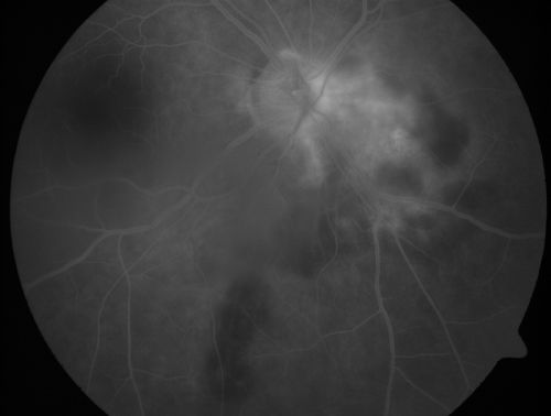 Serpiginouse Choroiditis (Chorioretinitis) - Acute Right Eye - Old Left Eye VA 20/25 OD , 20/50 OS
63-year-old woman has serpiginous choroiditis (date - March 2011).  The right eye has not been previously involved, and then she noticed new onset floaters in the right eye for the last two weeks.  Her vision in the right eye is hazy because of that.

VISUAL ACUITY:  Vision OD is 20/25, OS is 20/50
