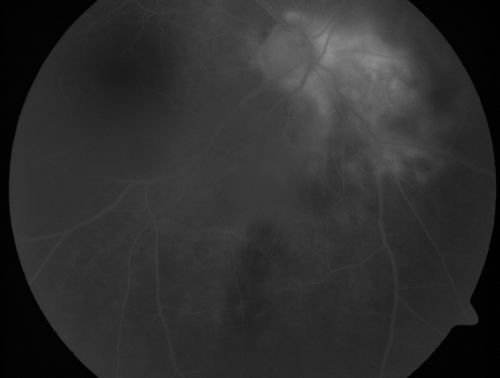 Serpiginouse Choroiditis (Chorioretinitis) - Acute Right Eye - Old Left Eye VA 20/25 OD , 20/50 OS
63-year-old woman has serpiginous choroiditis (date - March 2011).  The right eye has not been previously involved, and then she noticed new onset floaters in the right eye for the last two weeks.  Her vision in the right eye is hazy because of that.

VISUAL ACUITY:  Vision OD is 20/25, OS is 20/50
