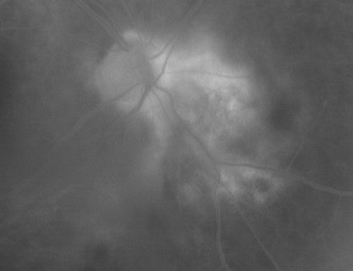 Serpiginouse Choroiditis (Chorioretinitis) - Acute Right Eye - Old Left Eye VA 20/25 OD , 20/50 OS
63-year-old woman has serpiginous choroiditis (date - March 2011).  The right eye has not been previously involved, and then she noticed new onset floaters in the right eye for the last two weeks.  Her vision in the right eye is hazy because of that.

VISUAL ACUITY:  Vision OD is 20/25, OS is 20/50

