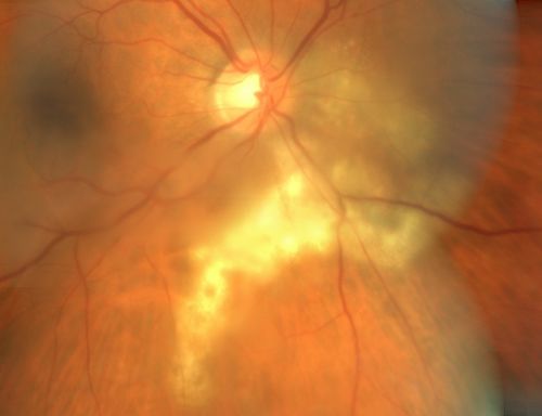 Serpiginouse Choroiditis (Chorioretinitis) - Acute Right Eye - Old Left Eye VA 20/25 OD , 20/50 OS
63-year-old woman has serpiginous choroiditis (date - March 2011).  The right eye has not been previously involved, and then she noticed new onset floaters in the right eye for the last two weeks.  Her vision in the right eye is hazy because of that.

VISUAL ACUITY:  Vision OD is 20/25, OS is 20/50

